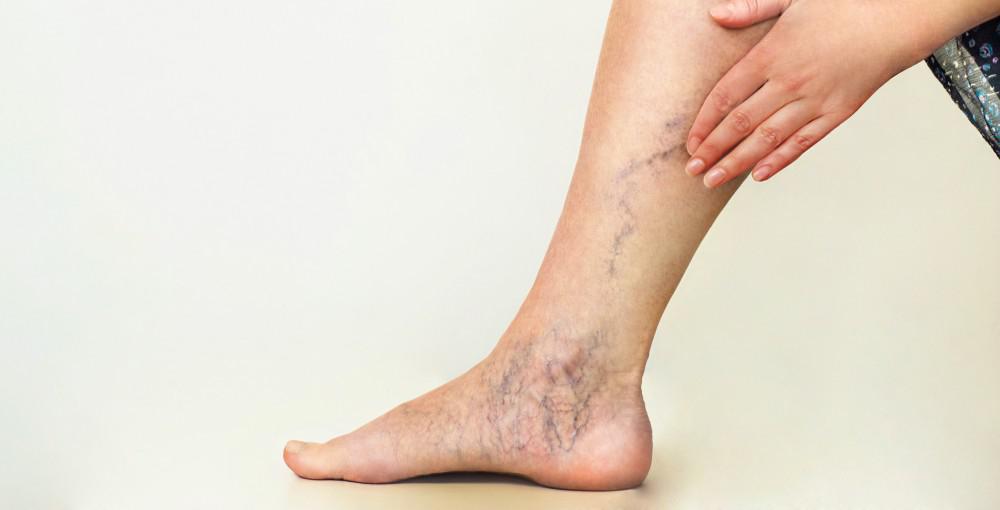 Vein Issues and Vein Medicines